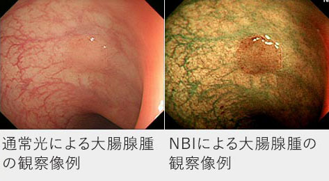 通常光による大腸腺腫の観察像例　NBIによる大腸腺腫の観察像例